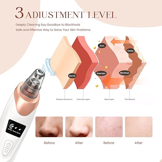 Blackhead Remover Pore Vacuum – Deep Cleansing Facial Skin Cleaner